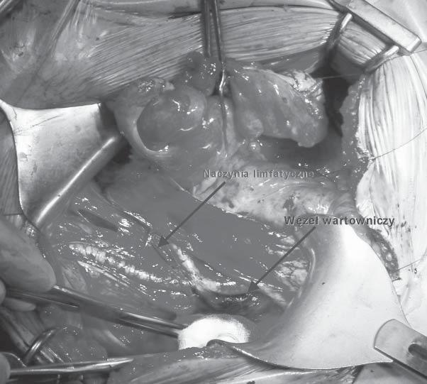 The SLN evaluation was carried out by two independent patomorphologists. The collected results were subjected to statistical analysis using the Chi 2 test.