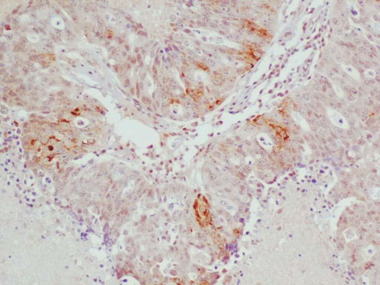 44 A. CZEKIERDOWSKI, S. CZEKIERDOWSKA, W. BEDNAREK, J. DANIŁOŚ, D. MORAWSKA Mean Id2 protein expression in the examined group represented as a point value was 5.5 (range 0-10).