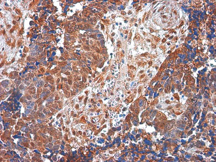 Id-2 protein expression and microvessel density assessment in various types of malignant ovarian tumors 45 depending on histological grading and FIGO staging were statistically insignificant.