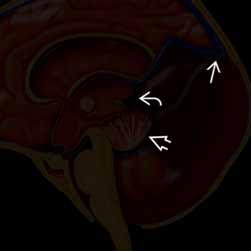 poszerzenie komory IV powiększona PF Hipoplastyczny robak, zrotowany ku górze HVR Różnego stopnia hipoplazja robaka PF/pień mózgu prawidłowych rozmiarów Brak lub niewielka torbiel, komora IV o