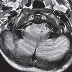 asymptomatycznych Ból głowy, ataksja, oczopląs, postępująca spastyczna tetrapareza Uwaga: przed rozpoznaniem CM1 zawsze należy poszukać objawów podciśnienia wewnątrzczaszkowego (Po lewej) Graficzny