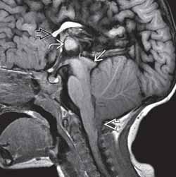 Malformacja Chiariego 2 Niedociśnienie wewnątrzczaszkowe Ciężkie, przewlekłe wrodzone wodogłowie z zastawką PATOLOGIA Wtórnie do przecieku CSF przez otwartą, dysraficzną cewę nerwową podczas rozwoju