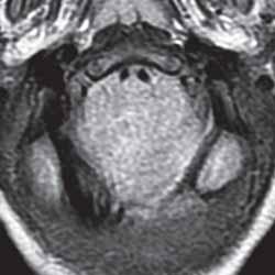 strzałkowym tylnego dołu czaszki i górnej części szyjnego odcinka rdzenia kręgowego przedstawia charakterystyczne dla malformacji Chiariego 2 objawy, w tym: dysgenezję spoidła wielkiego, dziobiastą