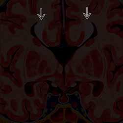 (kolpocefalia) DTI: w przypadku braku ciała modzelowatego włókna spoidła formują podłużne (nie krzyżujące linii pośrodkowej) pęczki Probsta Pionowo/tylny przebieg tętnicy przedniej mózgu ZAGADNIENIA