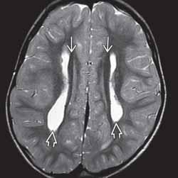 (Po prawej) Przekrój czołowy w obrazie T2-zależnym pacjenta z dysgenezją spoidła uwidacznia szeroko rozstawione komory boczne o wyglądzie hełmu Wikinga lub głowy łosia.