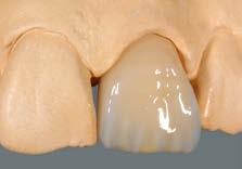 przy pomocy EFFECT ENAMEL flow EE9 lub EE2.