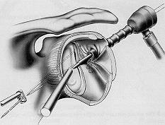 Arthroscopic