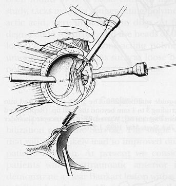 Arthroscopic
