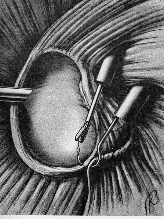 Arthroscopic