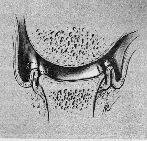 Arthroscopic Capsular