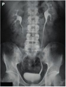 Zamieszczony obraz został wykonany metodą A. USG B. MRI C. PET D. TK Zadanie 14. Na rentgenogramie uwidoczniono badanie A. angiografii nerkowej TK. B. angiografii nerkowej. C. urografii TK. D. urografii. Zadanie 15.