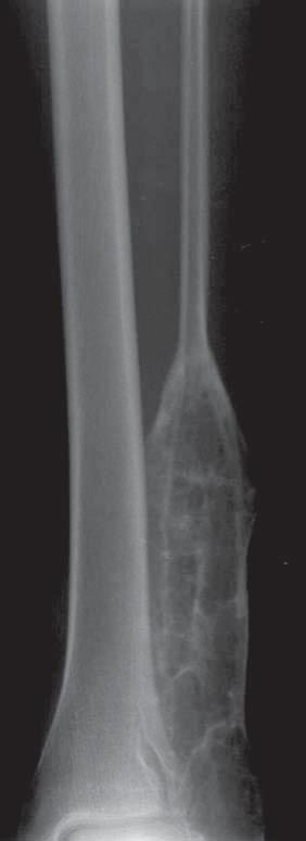 34 E. KLUCZEWSKA, E. KULETA-BOSAK, W. MADZIARA, J. MACHNIK-BRONCEL reveals characteristics of a benign lesion and permits a diagnosis.