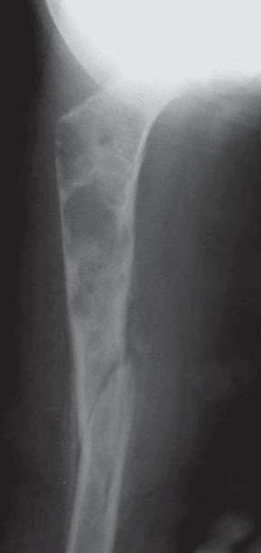 (cortex, endosteal surface, bone tissues), central or peripheral location, growth characteristics slow or aggressive with the formation of periosteum reactions or bone formation [13, 14, 15].