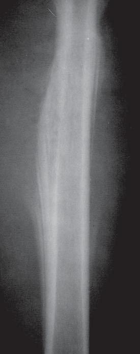 The cortical layer may be of varied thickness, but it is always preserved even, if it caused significant blowing up of the bone. At times, a benign tumor may contain osteoclerotic lesions.