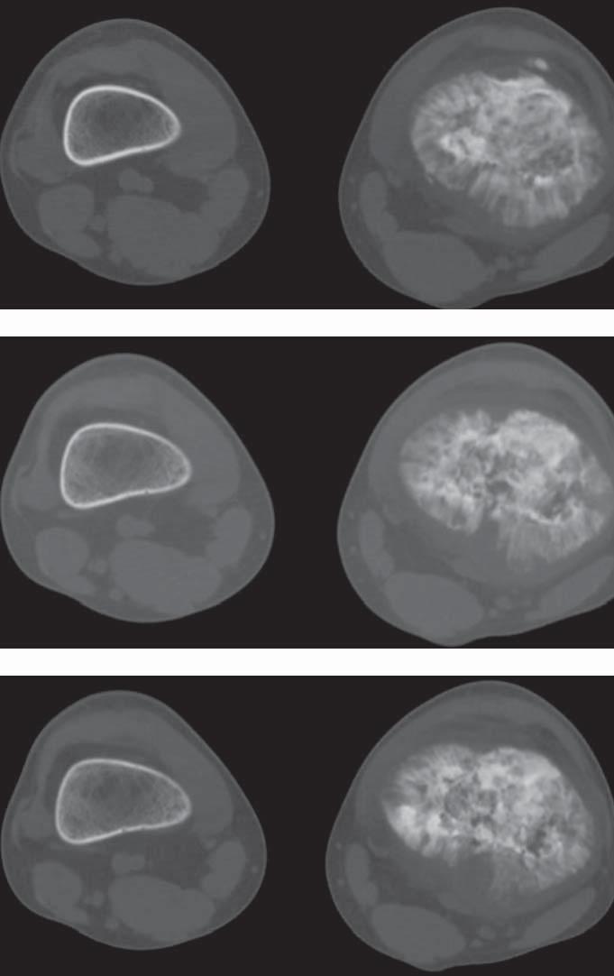 are no malignant reactions of the periosteum or the infiltration of the soft tissues [7, 16].