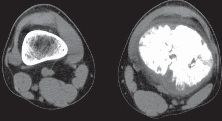 36 E. KLUCZEWSKA, E. KULETA-BOSAK, W. MADZIARA, J. MACHNIK-BRONCEL osteosclerotic thickening of bone structure carried a suspicion of expansion ability.