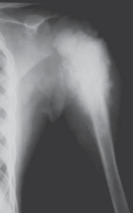 of the spine, ribs, and the pelvis. Multi-plane image reconstructions, carried out on multirow detector CTs allow for a better visualization of the primary focal area [22, 24, 25].