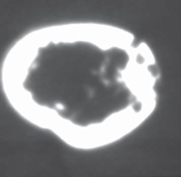 cartilage as well as the infiltration of soft tissues, relation of the tumor to the neighboring vascular and nerve 37 wych.