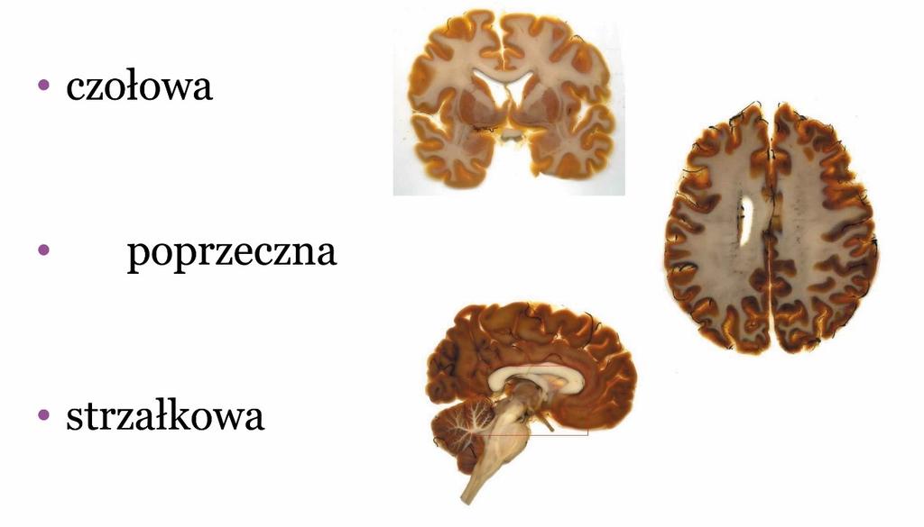 Przekrój poprzeczny (transversus) Przykład: mózgowie w różnych plaszczyznach przekroju: http://www.