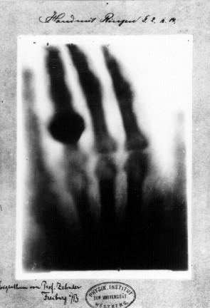 (angiografia) lub przewodu pokarmowego. odkrycie promieni X 8 listopada 1895 Wilhelm Conrad Röntgen http://www.