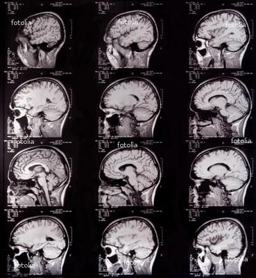 option=com_content&view= article&id=73:tomografia-komputerowa&catid=51:pracownie-diagnostyczne&itemid=67 Źródło promieniowania i detektory poruszają się po okręgu dookoła obrazowanej części ciała,