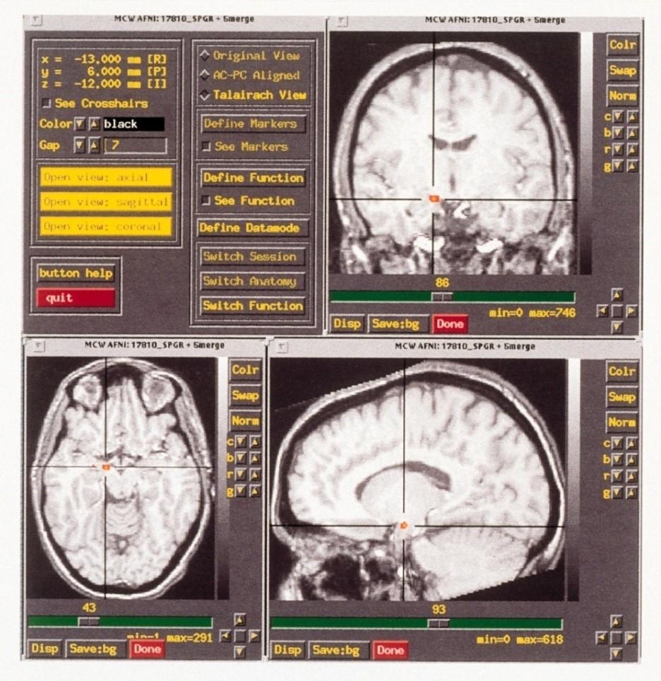 MRI (Magnetic Resonance Imaging) Obrazowanie metodą rezonansu magnetycznego -