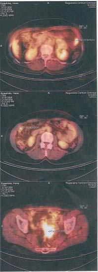 Exploratory laparotomy is referred to as golden standard in staging of ovarian cancer, however modern imaging techniques are being introduced to a more exact validation preoperatively.