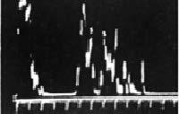 . Ryc. 3. Ultrasonogram oczodołu u zdrowej osoby w prezentacji A, z zaznaczonym kątem kappa stanowi tylna ściana gałki ocznej (na Ryc. 2 biała strzałka), z wyraźnie hiperechogeniczną twardówką.