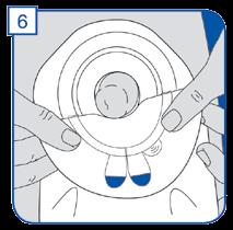 Aby zdjąć worek stomijny systemu dwuczęściowego, należy delikatnie odczepić worek od płytki stomijnej, zaczynając od górnej części worka, przytrzymując jednocześnie płytkę stomijną przyklejoną
