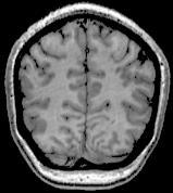 g., 6 mm