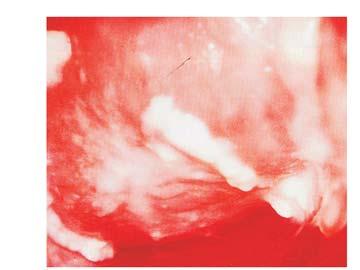 squamous epithelium which prior to the test with the acid seemed normal (photo 16).