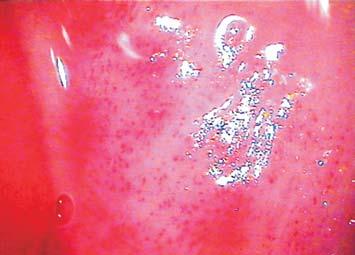 The surface of a whitening epithelial focus is shining and has got an uneven, rough, papillous surface.
