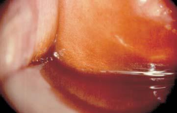 In the iodine test the epithelial whitening foci are iodine positive.
