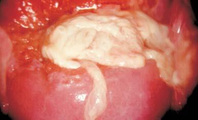 Objaw poziomkowy Photo 14. Vaginal mycosis Fot. 14. Grzybica pochwy Photo 15. Bacterial vaginosis.