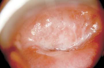 pearance of the red points. The iodine test negative. Vascularization abnormal (picture 1, photo 6). 3.