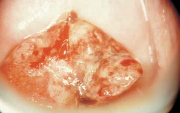 Epithelium white after the acetic acid test. Vast focus in contact with the cervical canal Fot. 5.