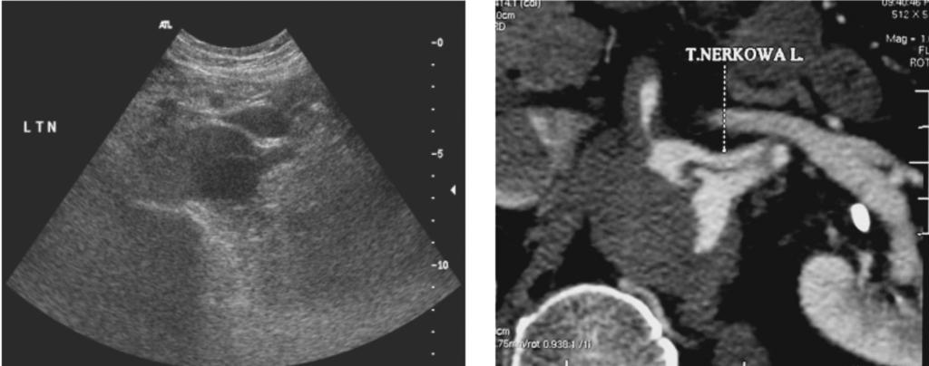 Left renal artery dissection US and CT presentation W tych wszystkich przypadkach uzyskane wyniki badań doplerowskich dotyczące niedrożności i zwężenia tętnic nerkowych były zgodne z wynikami badań