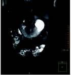 Coronal and sagi al T2-weighted magne c resonance urography images of horseshoe kidney, with hydronephrosis of the le collec ng system and high inser on of the ureter. Ryc. 1.