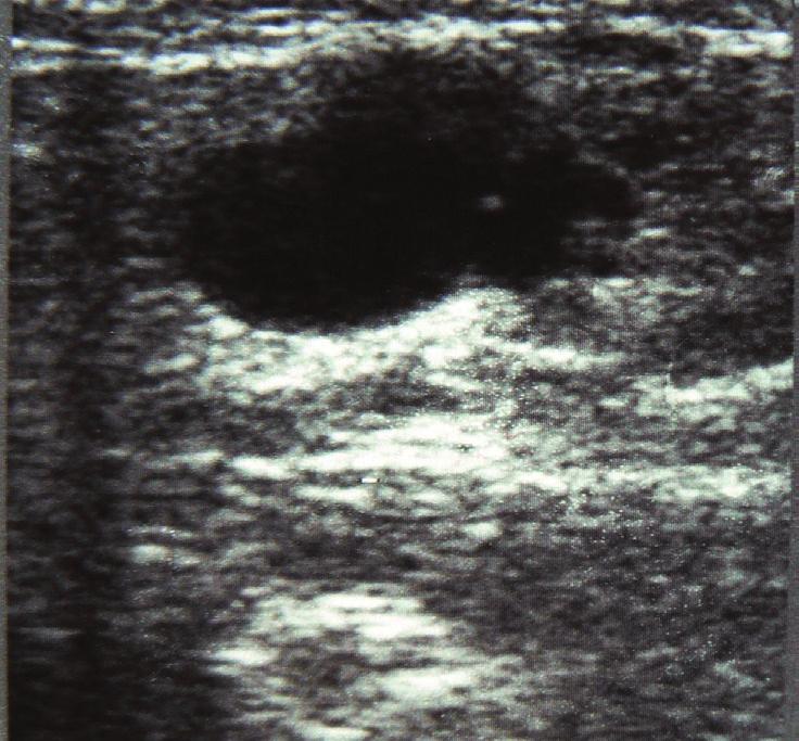 Obraz ultrasonograficzny guzów szyi w badaniu z zastosowaniem metody dopplerowskiej Ryc. 7.