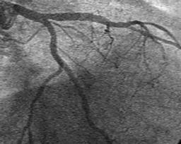 W miejscu zwężenia implantowano stent wieńcowy, uzyskując bardzo dobry wynik angiograficzny oraz w IVUS (B).