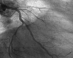 bez obecności negatywnej przebudowy naczynia. Fig. 3. Case example of the diffuse in-stent restenosis leading to total vessel occlusion.