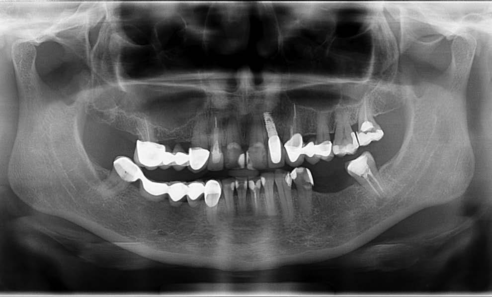 Zastosowanie cementu MTA w leczeniu perforacji dna komory opis przypadku wiązania w warunkach zmiennego ph oraz wilgotności środowiska, brakiem resorpcji w płynach tkankowych, wspomaganiem