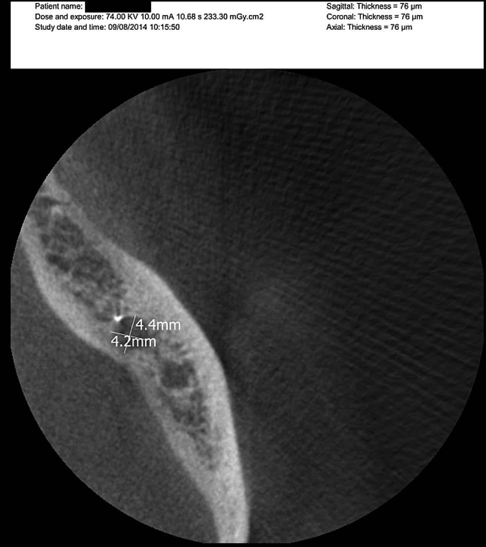 mineral trioxide aggregate), który stanowi mieszaninę proszku składającego się z cementu portlanckiego (70%), tlenku bizmutu (20%), gipsu oraz śladowych ilości tlenków krzemu, wapnia i magnezu, kwasu