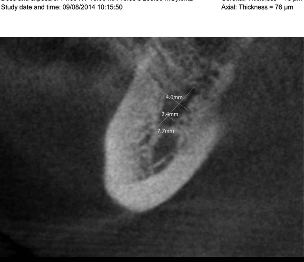 Alicja Porenczuk Ryc. 5. CBCT (ząb 37) projekcja osiowa. Lokalizacja pominiętego kanału bliższego językowego Ryc. 3. CBCT (ząb 37) projekcja czołowa.