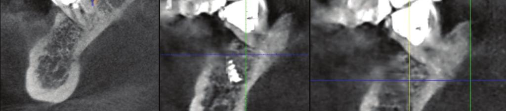 Podjęto próbę warunkowej rewizji leczenia endodontycznego zęba 37 z zamknięciem perforacji, na co uzyskano pisemną zgodę pacjentki.