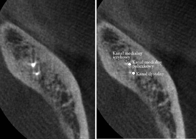 endometrem X-Smart Dual (Dentsply Sirona, York, USA) oraz narzędzi ultradźwiękowych. Perforacja o średnicy ok.