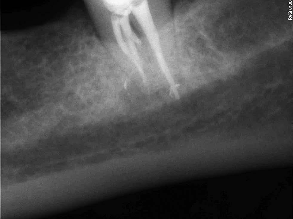Zastosowanie cementu MTA w leczeniu perforacji dna komory opis przypadku mocznika RC-Prep (Premier Dental, Plymouth Meeting, USA).