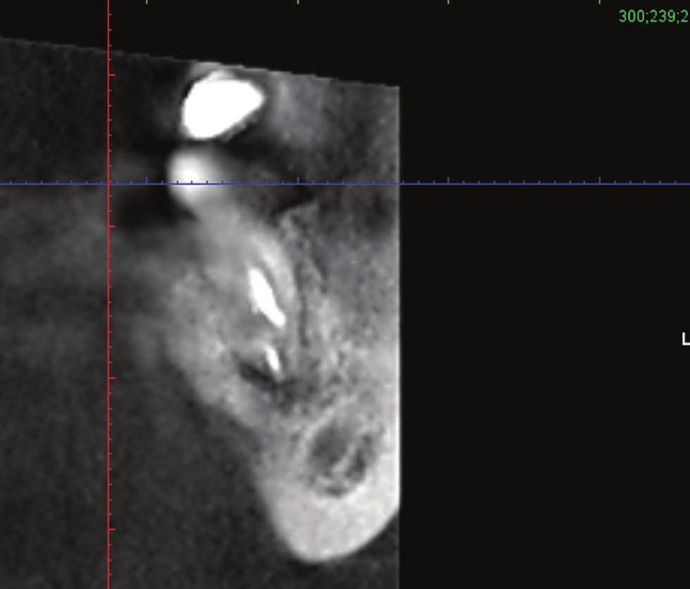 Kontrola radiologiczna potwierdziła szczelne wypełnienie kanałów na pełnych długościach, z nieznacznym nadmiarem w kanale D (ryc. 6).