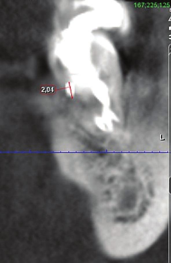 Alicja Porenczuk Ryc. 9. CBCT (ząb 37) projekcja czołowa. Obecność MTA zamykającego perforację w przestrzeni międzykorzeniowej Ryc. 10. Zdjęcie zębowe wewnątrzustne (ząb 37).