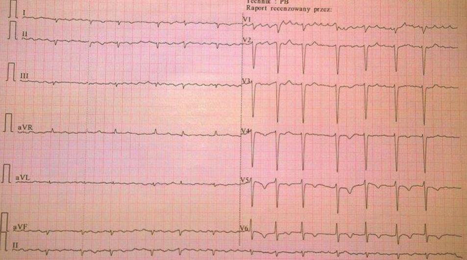 Kardiologia Inwazyjna nr 5 (10), ROK 2015 24 Rycina 1.